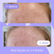 Forehead Wrinkle Patch