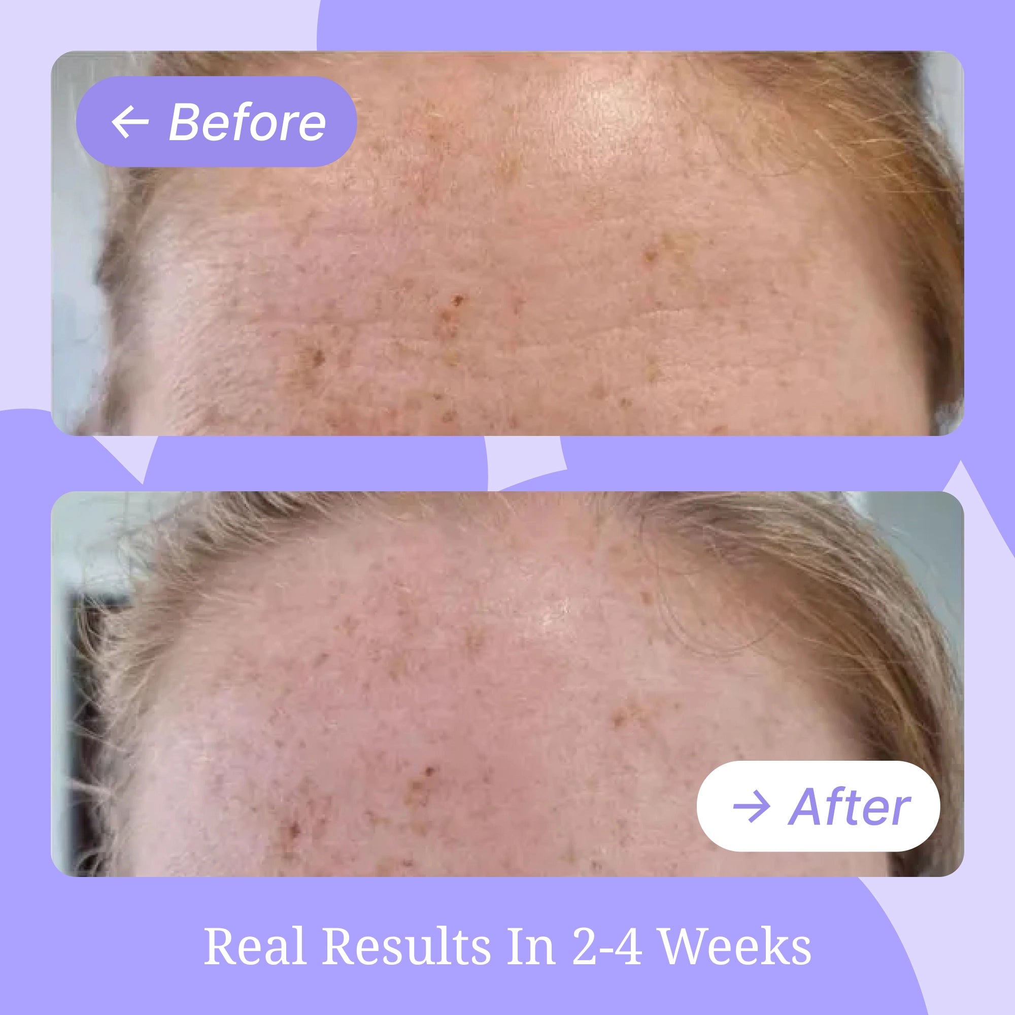 Forehead Wrinkle Patch